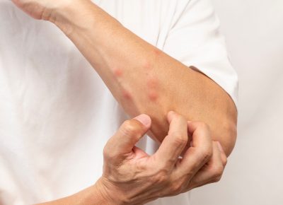 Guía Para Identificar Cada Picadura De Insecto