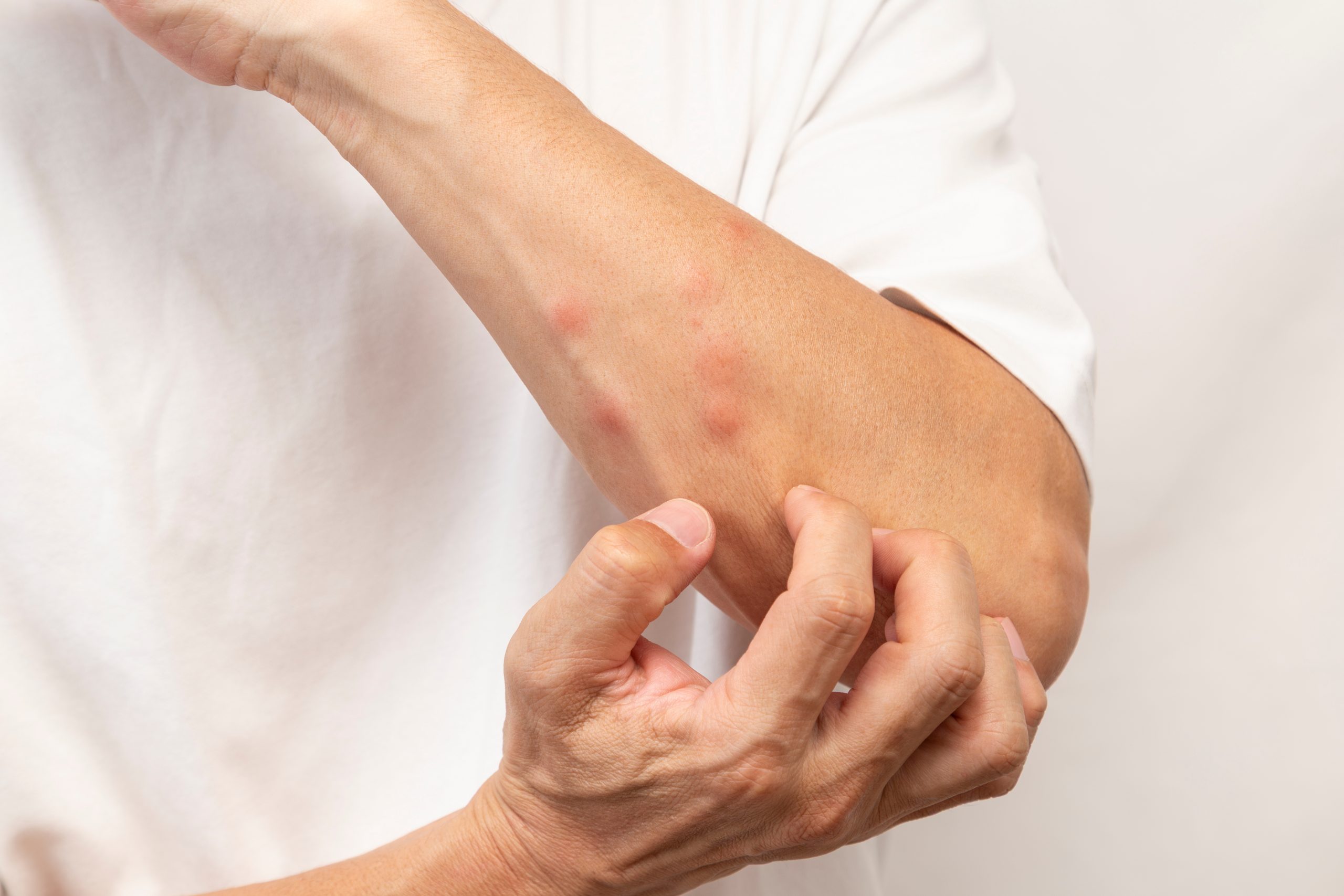 Guía Para Identificar Cada Picadura De Insecto